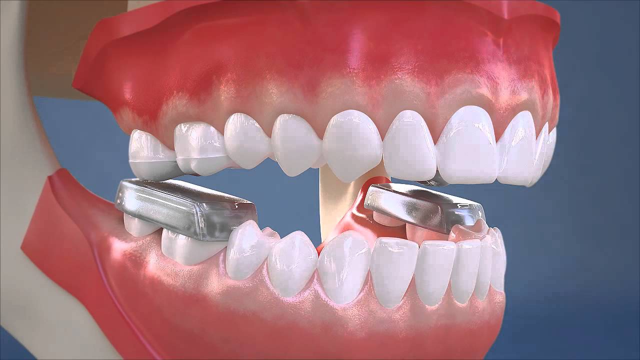 Post bite block for preparations